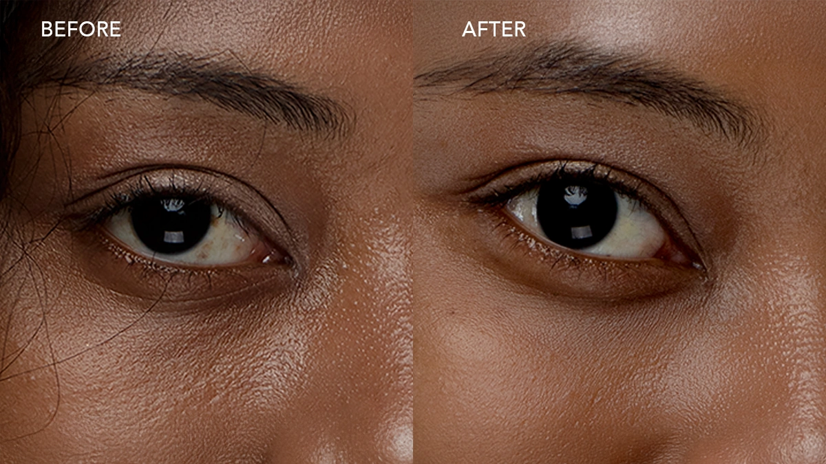 A woman with diminished puffines under eye before after lymphatic drainage with IRIS 2